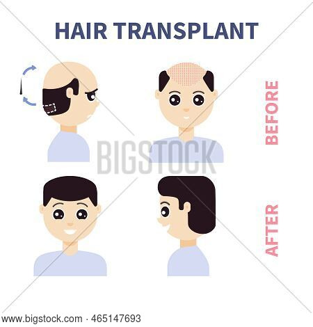 Fue Hair Transplant Treatment Of Alopecia Illustration