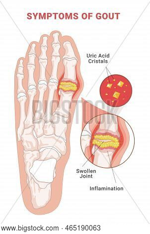 Symptoms Of Gout Infographic Scheme Vector Flat Human Foot With Crystallization Of Uric Acid