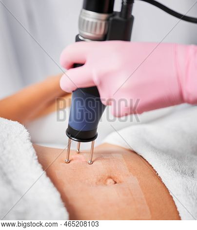 Close Up Cosmetologist Hand In Sterile Gloves Using Erbium Ablative Laser Machine While Performing L