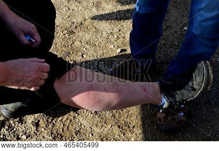 Adult Woman\'s Leg Abraded From Falling On Slippery Rock Or Grass On A Hiking Trip. Skin Abrasions H