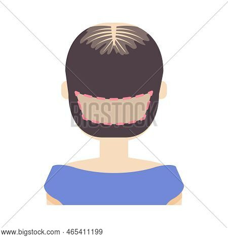 Fue Hair Transplant Treatment Of Alopecia Illustration