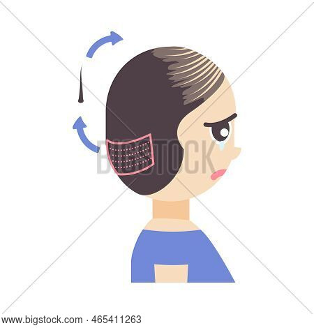 Fue Hair Transplant Treatment Of Alopecia Illustration
