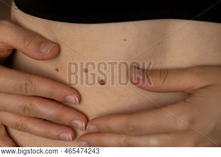 Unrecognizable Woman Showing Her Birthmarks On Skin Close Up Detail Of The Bare Skin Sun Exposure Ef