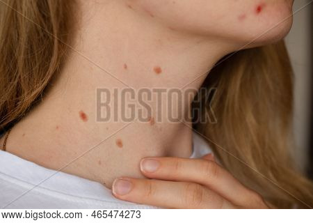 Unrecognizable Woman Showing Her Birthmarks On Neck Skin Close Up Detail Of The Bare Skin Sun Exposu