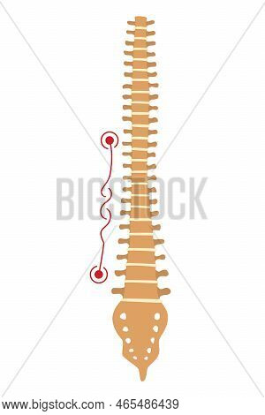 Spinal Deformity. Symbol Of Spine Curvatures Or Unhealthy Backbones. Human Spine Anatomy, Curved Spi