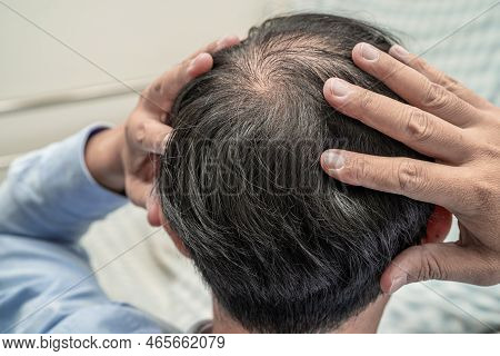 Bald In The Middle Head And Begin No Loss Hair Glabrous Of Mature Asian Business Smart Active Office