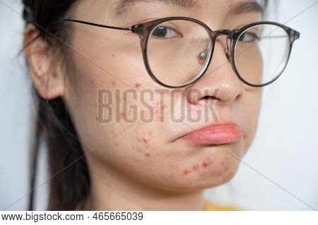 Boring Asian Woman Having Acne Inflamed On Her Face. Inflamed Acne Consists Of Swelling, Redness, An