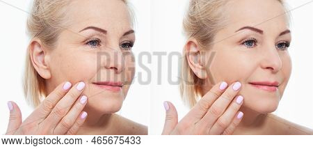 Middle Age Close Up Woman Face Before After Cosmetic Procedures. Skin Care For Wrinkled Face. Before