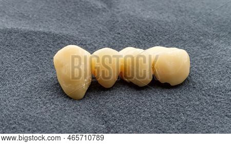 Provisional Dental Bridge Isolated On Grey Background. Temporary Resin Teeth. Dental Health And Impl