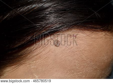 Intradermal Nevus Or Single Mole At The Forehead Of Southeast Asian, Myanmar Young Woman. It Is Simp