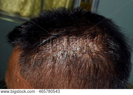 Seborrheic Dermatitis At The Scalp Of Southeast Asian, Myanmar Adult Male Patient.  Lateral View.