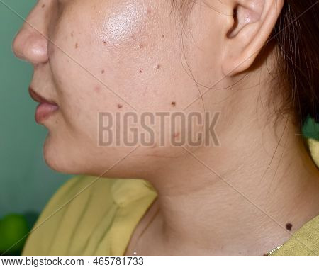 Acne Vulgaris And Black Spots On The Cheek Of Southeast Asian Woman. Acne Occurs When Hair Follicles