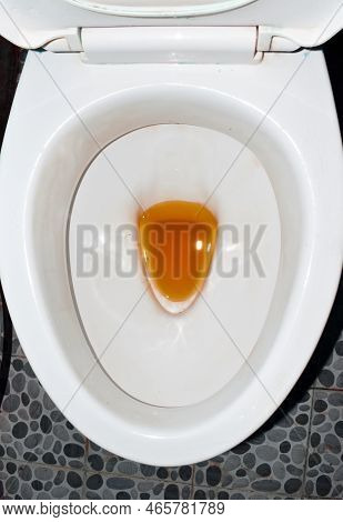 High Coloured Urine In Toilet. High Colored Urine Occurs In Hepatitis, Leptospirosis Disease, Hemoly