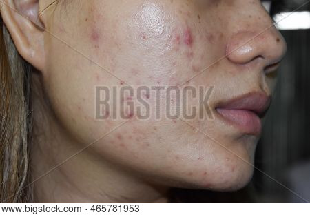 Acne Vulgaris And Scars Over Whole Face Of Southeast Asian Woman. Acne Occurs When Hair Follicles Be
