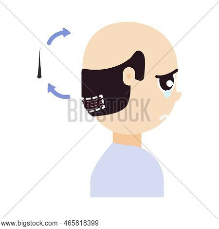 Fue Hair Transplant Treatment Of Alopecia. Side View Of A Man. Male Hair Loss Pattern. Medical Infog