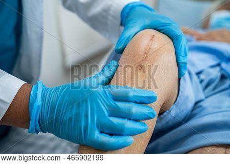 Asian Senior Or Elderly Old Lady Woman Patient Show Her Scars Surgical Total Knee Joint Replacement 