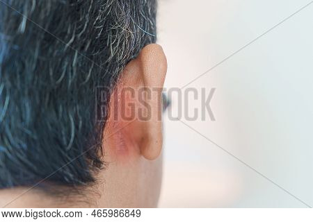 Man Having Ear Problems Due To Seborrheic Dermatitis, Psoriasis, Ringworm And Fungal Skin Infection