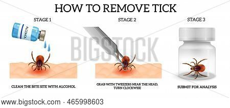 Realistic Spider Mite Remove Infographics With Three Stages Of How To Remove Tick Vector Illustratio