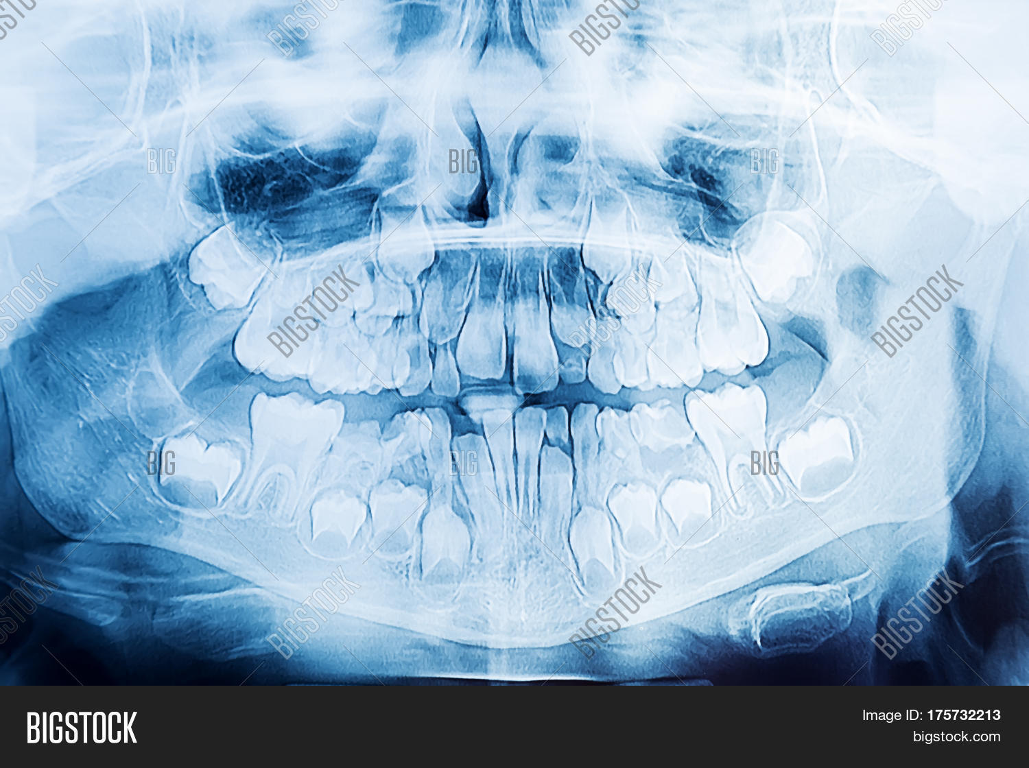 Children Dental Xray Image & Photo (Free Trial) Bigstock