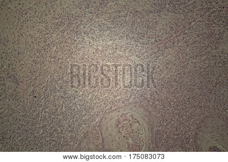 Cells of human skin with squamous cell carcinoma under a microscope.