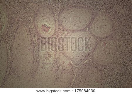 Cells of human skin with squamous cell carcinoma under a microscope.