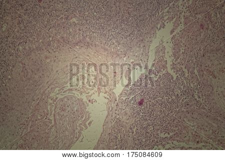 Cells of human skin with squamous cell carcinoma under a microscope.