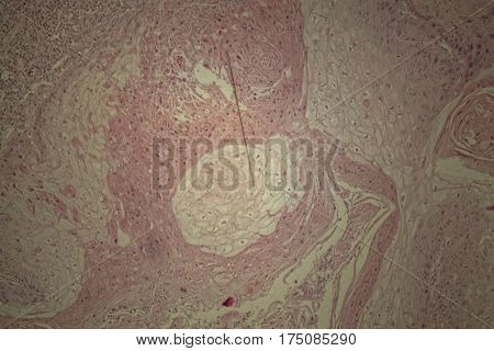 Cells of human skin with squamous cell carcinoma under a microscope.