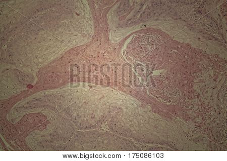 Cells of human skin with squamous cell carcinoma under a microscope.