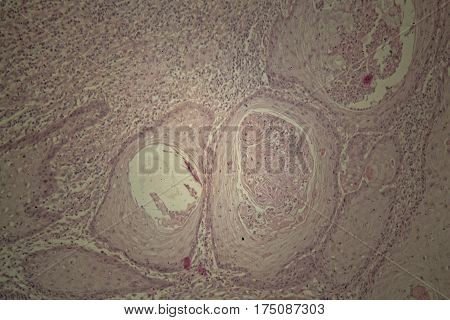 Cells of human skin with squamous cell carcinoma under a microscope.
