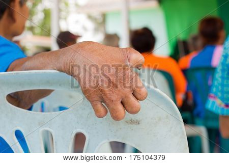 closeup hand of old asian woman suffering from leprosy amputated hand