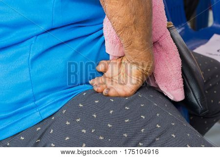 closeup hand of old asian woman suffering from leprosy amputated hand