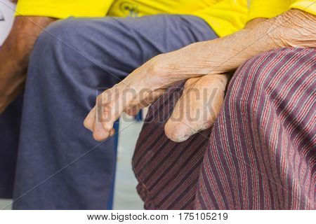 closeup hand of old asian man suffering from leprosy amputated hand