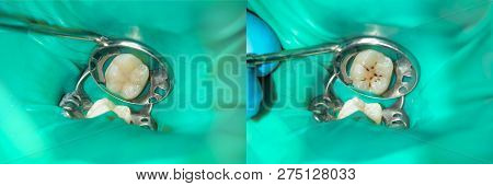 Close-up Of A Human Rotten Carious Tooth At The Treatment Stage In A Dental Clinic. The Use Of Rubbe