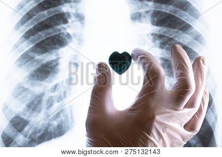 A Hand In A White Medical Glove Puts A Stone Heart On A X-ray Of Fluorographic Shot. Concept Of Hear