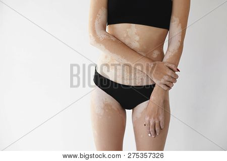 Cropped Image Of Young Woman With Skin Auto Immune Condition Disorder Posing Indoors. Studio Shot Of