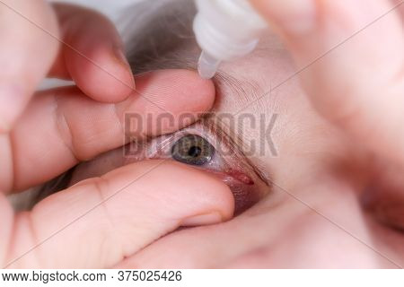 Human Eye With Some Blood Vessels On Sclera During Its Dripping With Eye Drops, Close-up In Selectiv