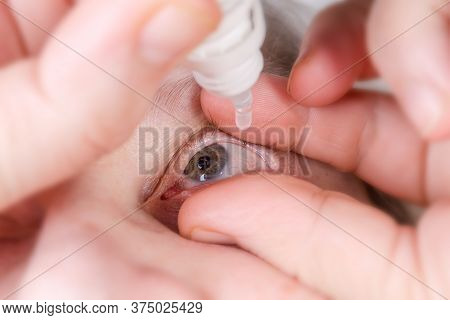Human Gray Eye With Some Blood Vessels On Sclera During The Dripping With Eye Drops, Close-up In Sel