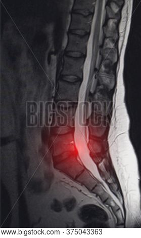 Image After Examination Of Magnetic Resonance Imaging. Spine Examination Concept, Otseochondrosis, L