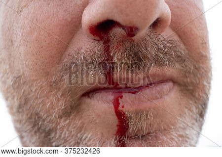 Nosebleed , A Man Is Bleeding From His Nose