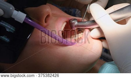 Drilling teeth and sucking saliva with ejector. Young woman at dental clinic. Female dentist with assistant treating cavities in a patient mouth in modern dental office.