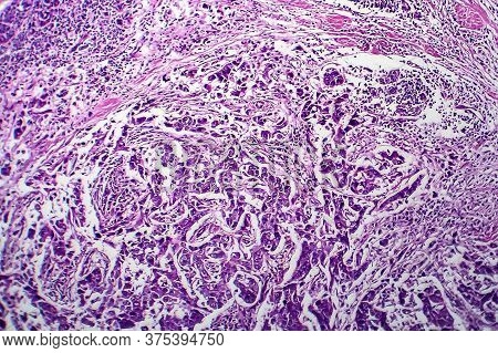 Breast Ductal Carcinoma, Light Micrograph, Photo Under Microscope