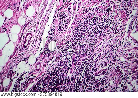 Breast Ductal Carcinoma, Light Micrograph, Photo Under Microscope