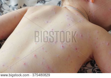 Close-up Of A Small Child With Chickenpox Virus Or Chickenpox Bubble In A Hurry