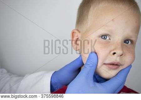 An Allergist Or Dermatologist Examines Red Spots On A Child’s Face. The Boy Suffers From A Rash, Hiv