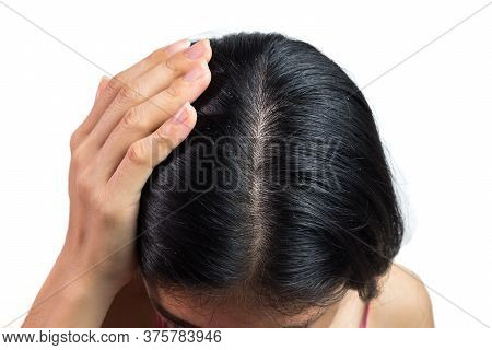 Women Head With Dandruff Caused By The Problem Of Dirty. Or Caused By Skin Disease Or Seborrheic Der