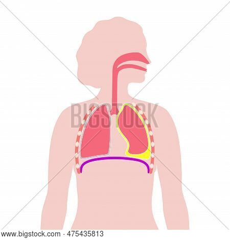 Chylothorax Disease. Lymphatic Fluid Between Layers Of Tissue In Lungs And Chest Wall. Severe Cough,