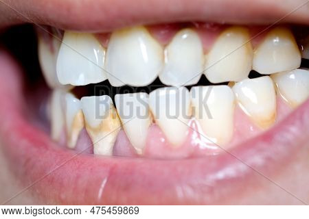 Tooth's A Man Smoking Bad. Man Smokes A Cigarettes Have Tooth Decay And Calculus On Teeth, So We Sho