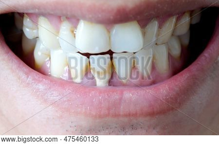 Tooth's A Man Smoking Bad. Man Smokes A Cigarettes Have Tooth Decay And Calculus On Teeth, So We Sho