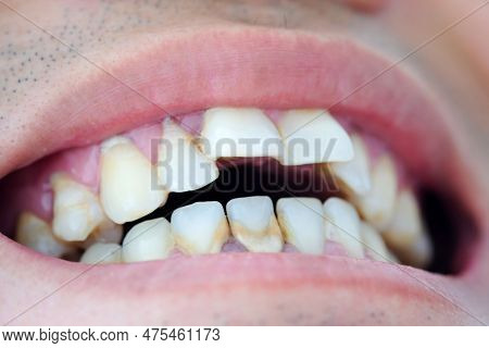 Tooth's A Man Smoking Bad. Man Smokes A Cigarettes Have Tooth Decay And Calculus On Teeth, So We Sho