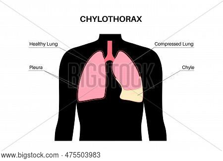 Chylothorax Disease. Lymphatic Fluid Between Layers Of Tissue In Lungs And Chest Wall. Severe Cough,